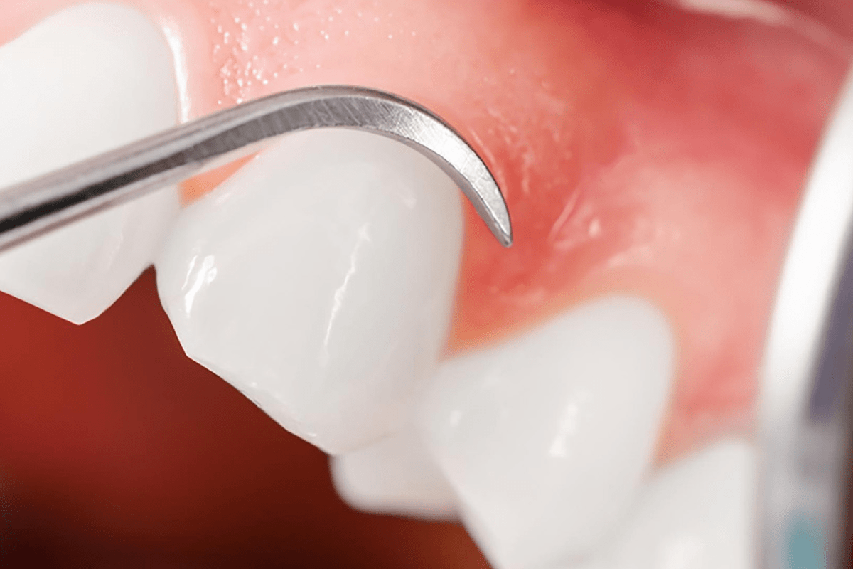 https://www.dentakgul.com/wp-content/uploads/2023/06/periodontoloji.png