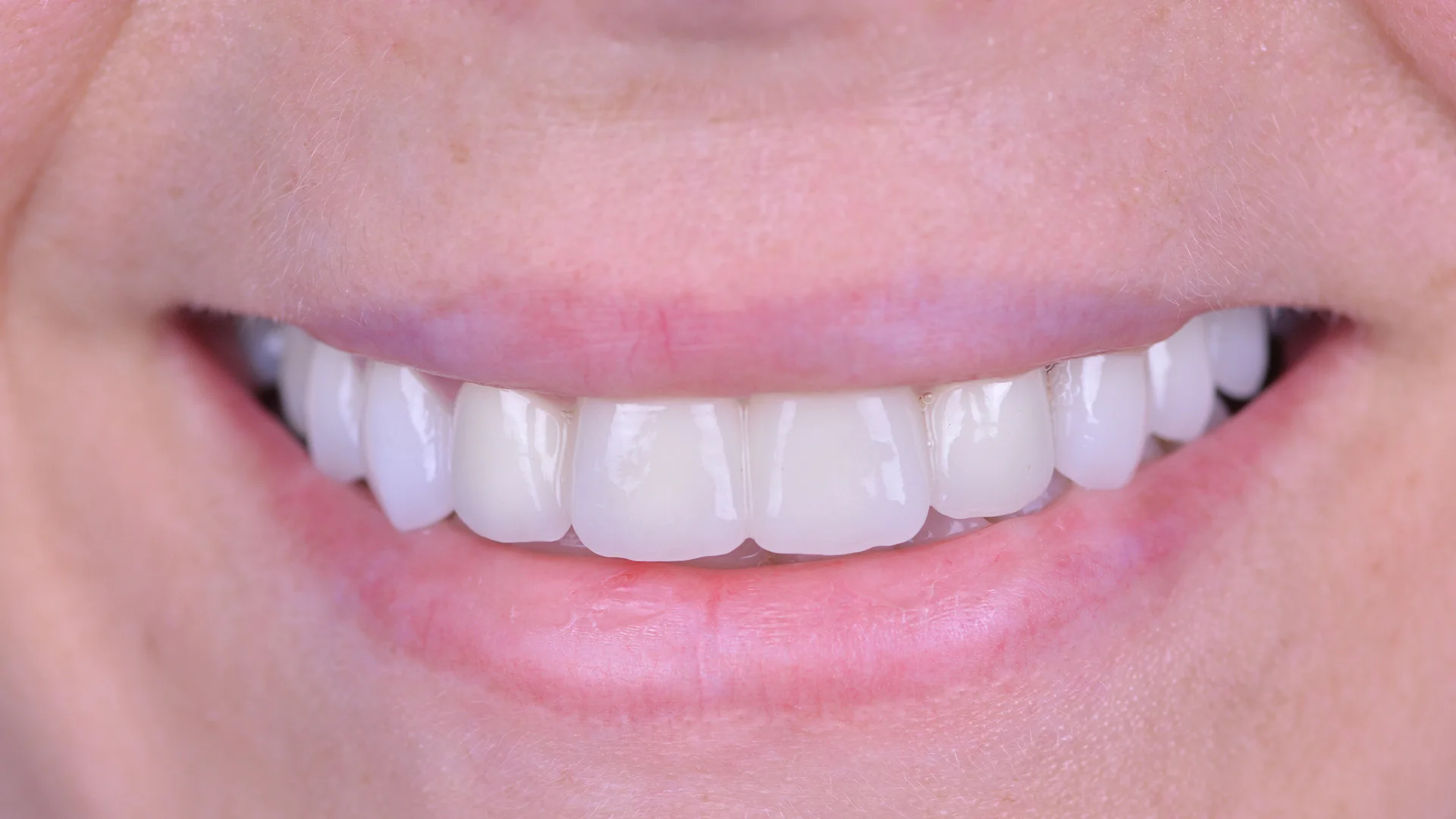 Protetik Restorasyonlar https://www.dentakgul.com/wp-content/uploads/2023/06/protetik1.jpg