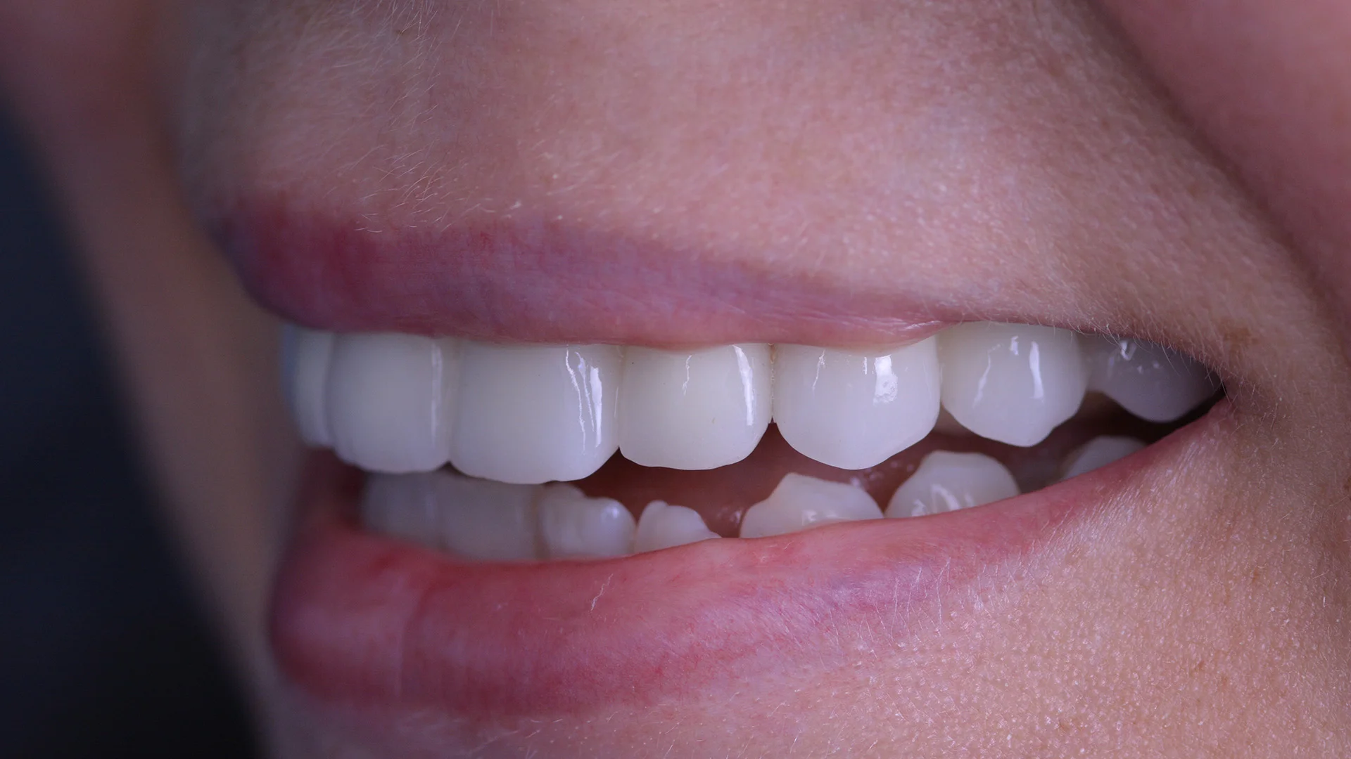 Protetik Restorasyonlar https://www.dentakgul.com/wp-content/uploads/2023/06/protetik2-2.jpg